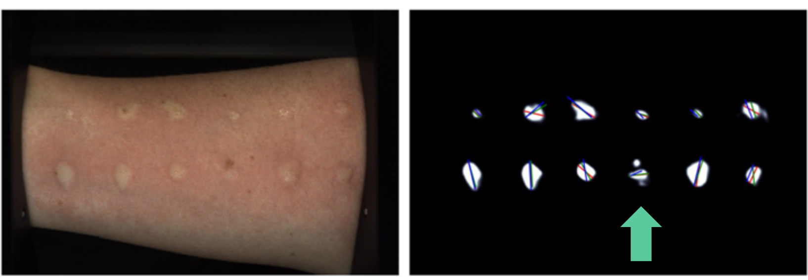 SPAT skin prick test: forearm wheals and the AI readout, with a missed (false-negative) wheal